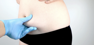 Liposuction Results Near Alexandria Virginia